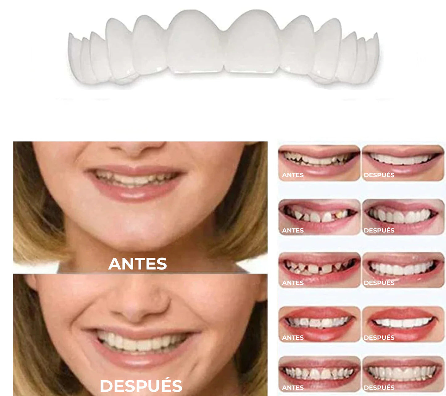 Carillas Dentales Snapon Smile Recupera tu sonrisa en minutos